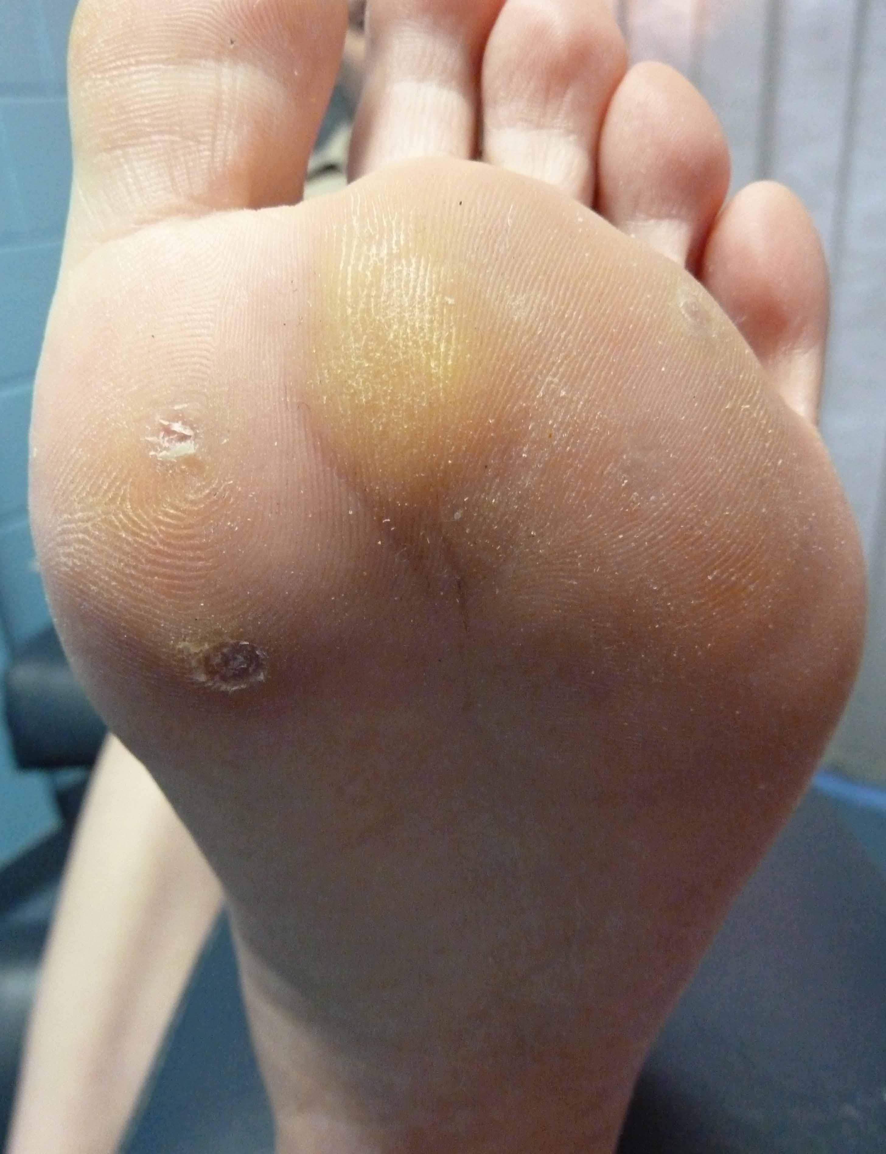 Plantar Wart Removal Warts