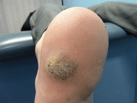 wart-200