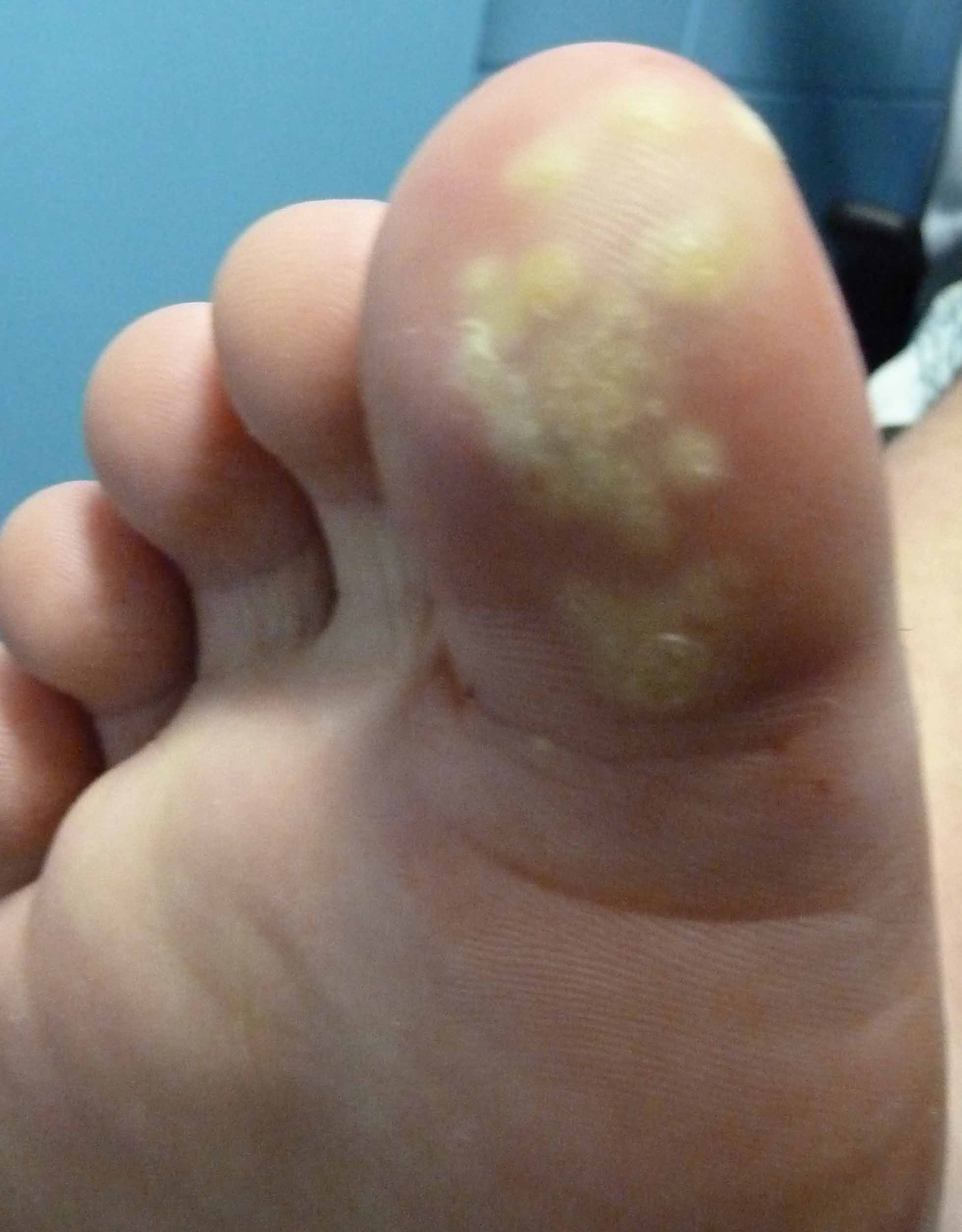 Plantar wart - Wikipedia