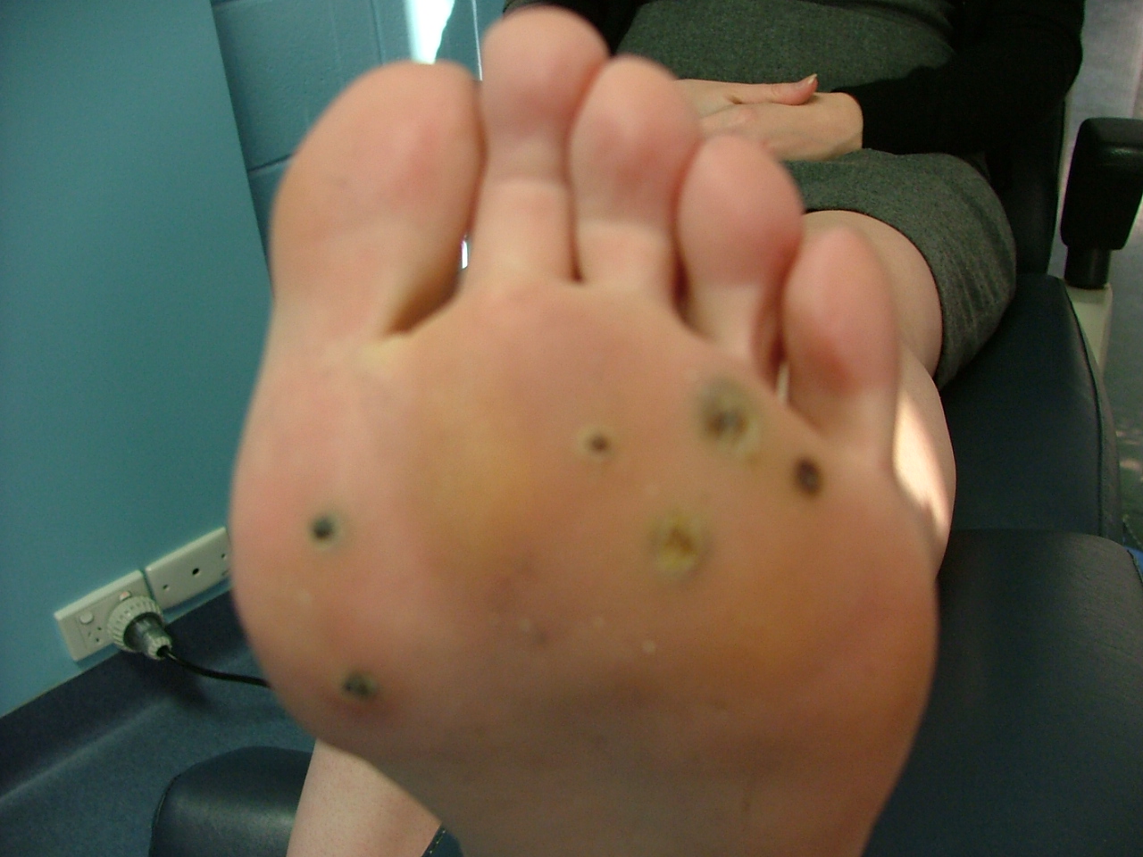 Planters wart removal video