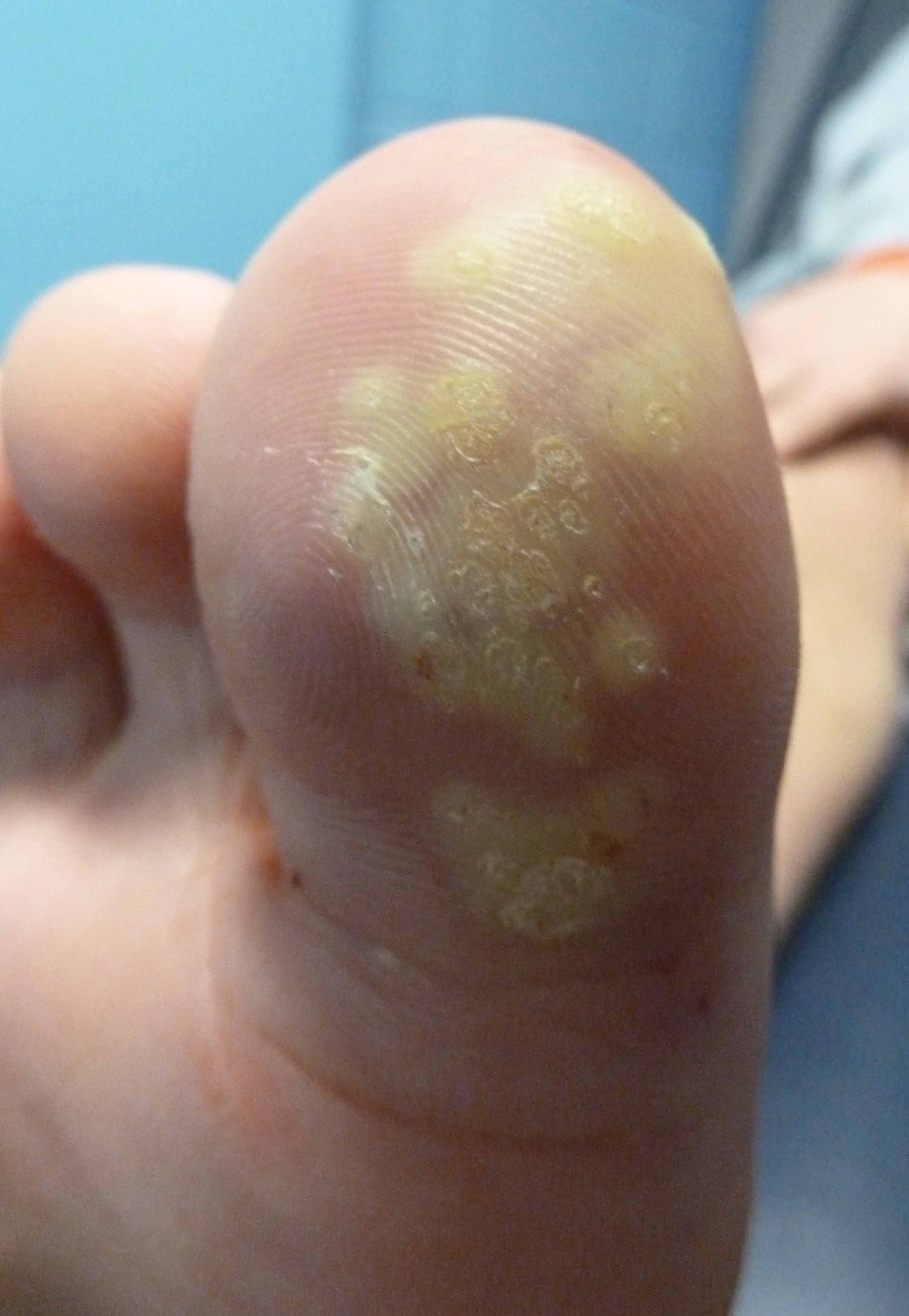 plantar warts