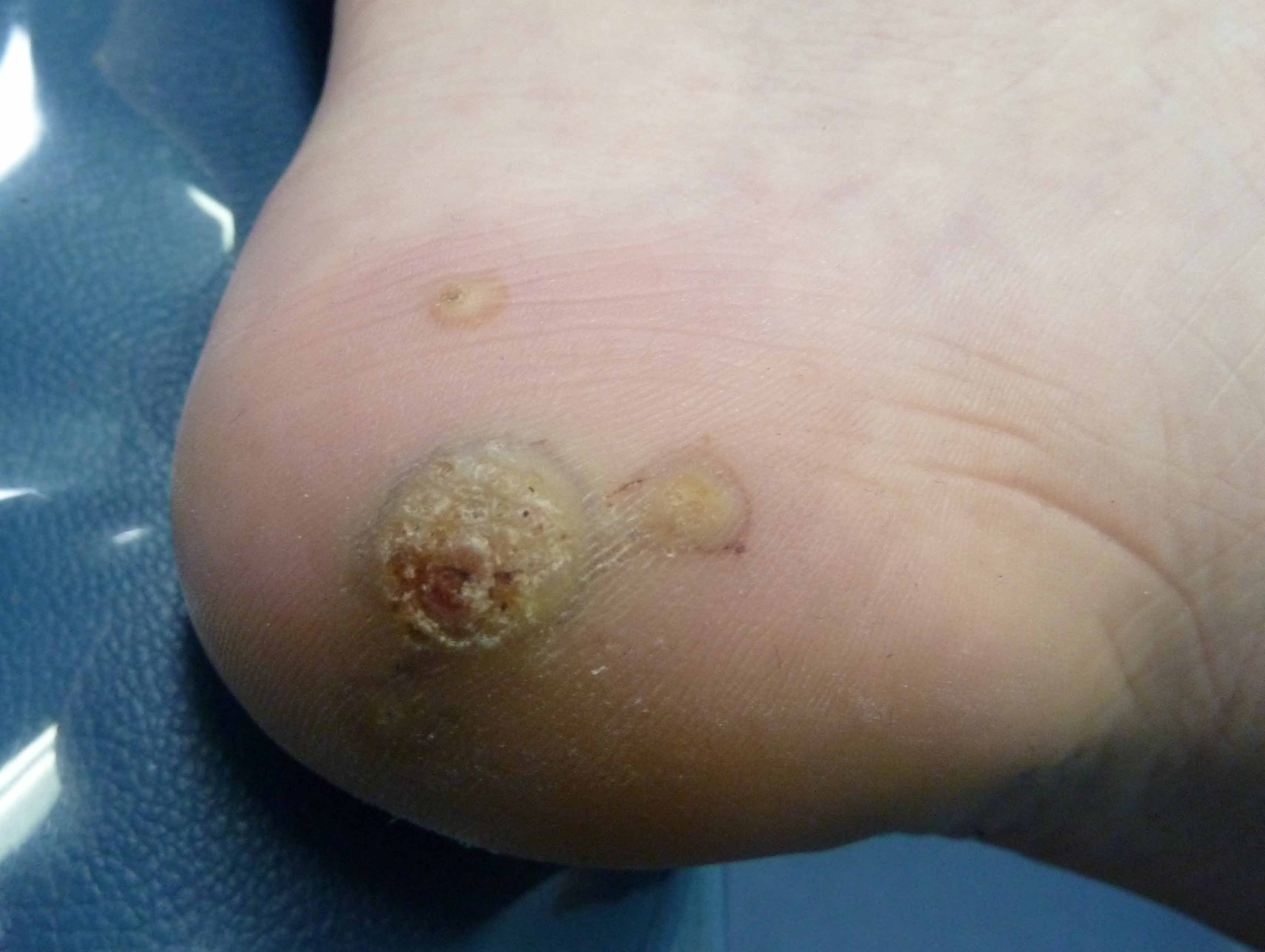 Picture of Viral Skin Diseases and Problems - Plantar Warts