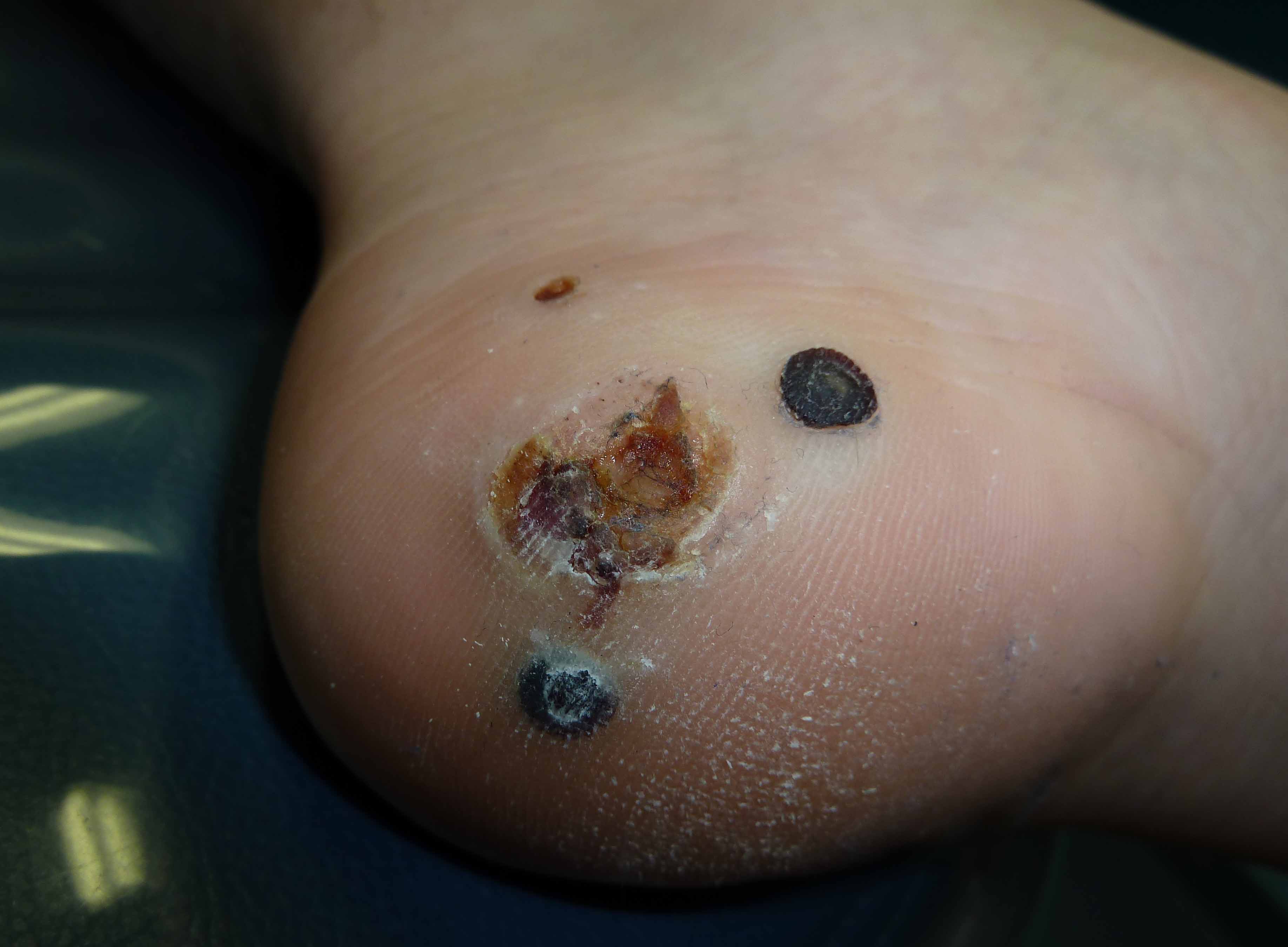 Plantar wart - Wikipedia