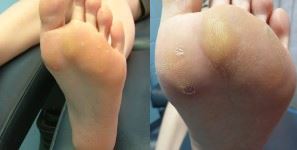 Plantar Wart Removal