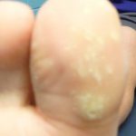 Laser Plantar Wart Treatment 1