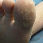 Laser Plantar Wart Treatment 2