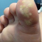 Laser Plantar Wart Treatment 3