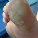 Laser Plantar Wart Treatment 4