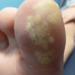 Laser Plantar Wart Treatment 5