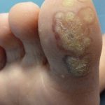 Laser Plantar Wart Treatment 6