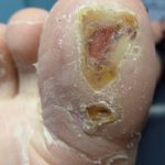 Laser Plantar Wart Treatment 7