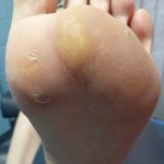 after plantar wart removal