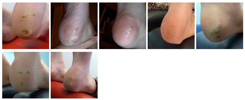 Plantar Warts Case Study