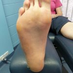 Plantar Wart Case Study 1 -3