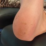 Plantar Warts Case Study 4