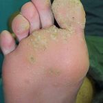 Plantar warts laser treatment Case Study 1