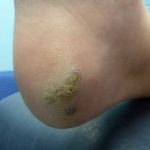 Plantar Warts Case Study 5