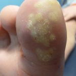 Plantar warts laser treatment Case Study 4