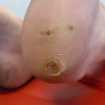 Plantar Warts Case Study 1