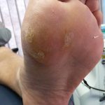 Plantar warts laser treatment Case Study 5