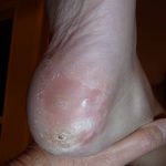 Plantar Warts Case Study 2