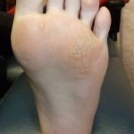 Plantar warts laser treatment Case Study 6