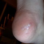 Plantar Warts Case Study 3