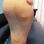 Plantar warts laser treatment Case Study 7