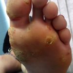 Plantar warts laser treatment Case Study 8