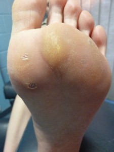 removing plantar warts after