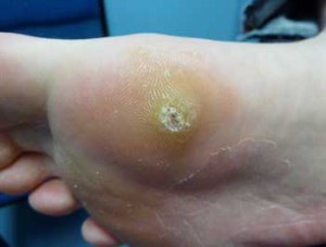 Plantar Wart Treatments