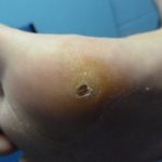 Plantar Wart Treatments -7