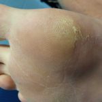 Plantar Wart Treatments -8