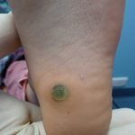 Plantar Wart Treatments