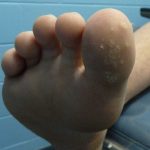 Plantar Wart Treatments -1