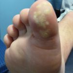 Plantar Wart Treatments -2