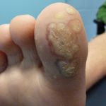 Plantar Wart Treatments -3