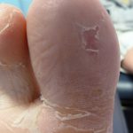 Plantar Wart Treatments -4