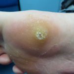 Plantar Wart Treatments -5