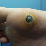 Plantar Wart Treatments -6