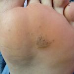 Plantar Wart Treatment Case Study 2 -1