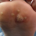 Plantar Wart Treatment Case Study 2 -2