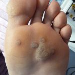 Plantar Wart Treatment Case Study 2 -3