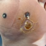 Plantar Wart Treatment Case Study 2 -4