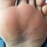 Plantar Wart Treatment Case Study 2 -5