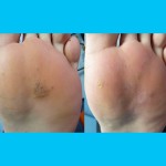 Plantar Wart Treatment