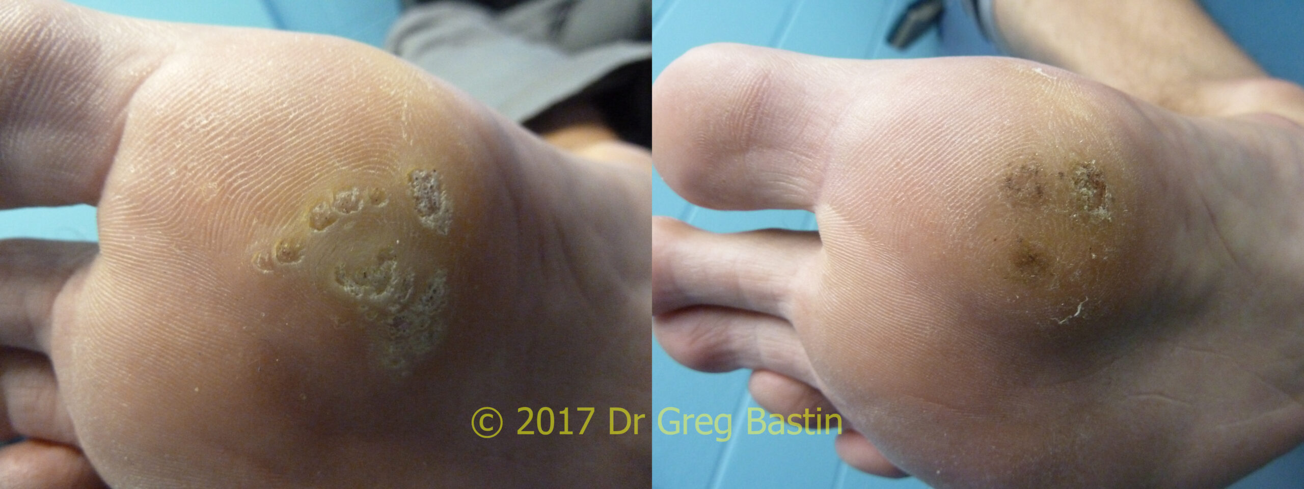 Does removing plantar warts hurt