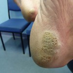 what are plantar warts