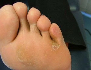 Plantar Warts after Laser Treatment