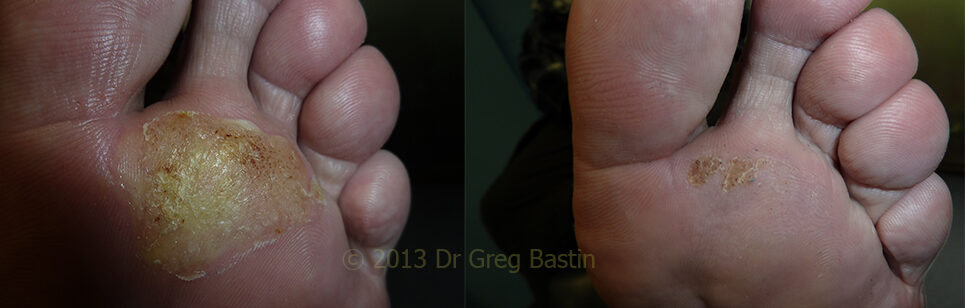 Wart Removal Specialist in Melbourne